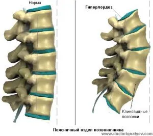 osteohondropatija гръбнака причинява, диагностика и лечение