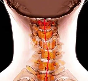 osteohondropatija гръбнака причинява, диагностика и лечение