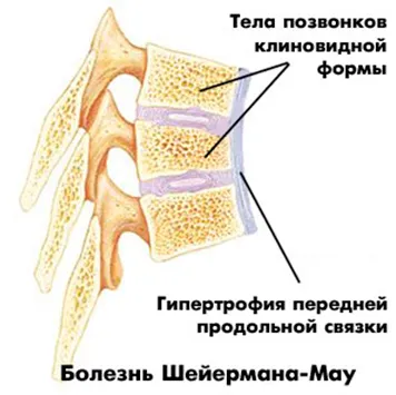 Osteohondropatija гръбначния стълб симптоми, причини и лечение