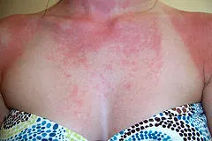 Алергия към слънцето, светът на жените