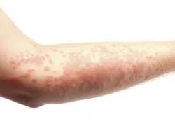 Алергия към майонеза - не е мечта домакиня