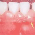 gingivită atrofică