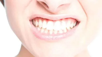 gingivită atrofică