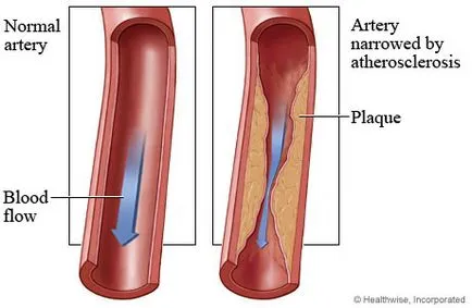 Ateroscleroza și arterioscleroza tratament