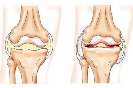 Osteoartrita (osteoartrita) - tratament, simptomele și prevenirea