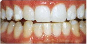 Fehér foltok a fogakon jelenti, hogy távolítsa el pontokat gyermek és felnőtt