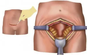 Sarcina dupa chist ovarian laparoscopic