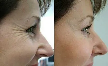 fotografii cu Botox înainte și după procedura, în conformitate cu recomandarea BOTOX