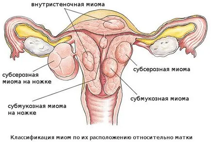 Borovaya uter cu fibroame