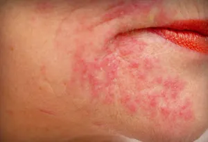 Hogyan kell kezelni allergiás az arc - Tippek és receptek