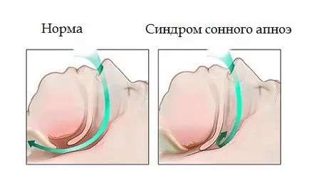 Какво става, ако съпругът е хъркането съвет и лечение препоръки