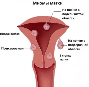 Ceea ce nu poate fi la exercitarea miom uterin, nutriție, tan