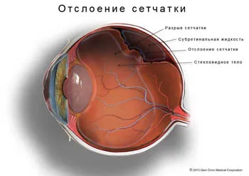 Tratamentul retiniana ochi dezlipire caracteristici noi metode de chirurgie