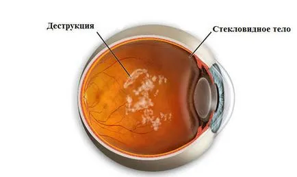 Унищожаване на стъкловидното окото (DST) - риск от заболяване, причината и текущото лечение