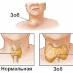 Дифузни симптоми гуша с щитовидната жлеза и признаци на заболяването