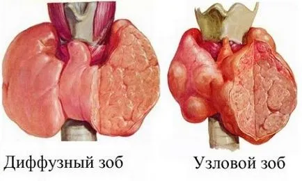 Дифузни симптоми гуша с щитовидната жлеза и признаци на заболяването