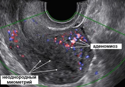 Дифузната маточни симптоми аденомиоза и лечение