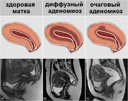 Difuz simptome adenomiozei uterine și tratament