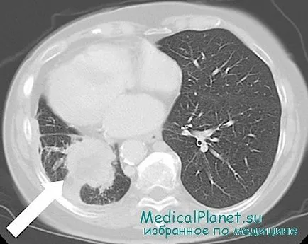 toracotomie de diagnostic pentru cancerul pulmonar