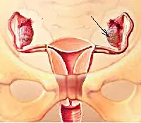 Tumorile benigne ale ovarelor - cauze, simptome, diagnostic și tratament