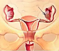 Jóindulatú daganatok a petefészkek - okai, tünetei, diagnózis és kezelés