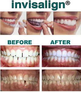 Rajtbírók kijavítani malocclusion nélkül fogszabályozó!