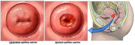 Metode eficiente de tratament de eroziune, consilii ale femeilor cervicale