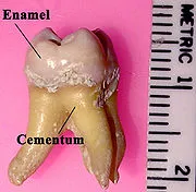 Emailată (dentare) - un