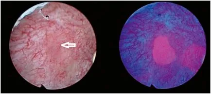 Fotodinámiás diagnózisa hólyagrák által cystoscopia