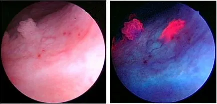 Diagnosticul fotodinamica a cancerului vezicii urinare prin cistoscopie