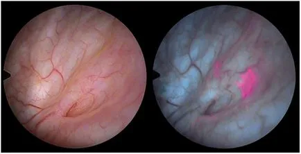 Diagnosticul fotodinamica a cancerului vezicii urinare prin cistoscopie