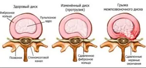 Gimnastica hernie coloanei vertebrale foto, video