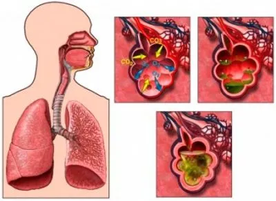 Purulentă bronșită simptome și tratament de repaus alimentar, antibiotice, remedii populare