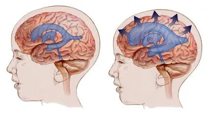 мозъка хидроцефалия в детските симптоми, лечение и възможните последици