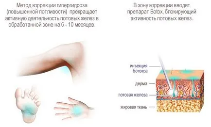 Хиперхидроза причини, симптоми, традиционни терапии