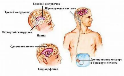 мозъка хидроцефалия в детските симптоми, лечение и възможните последици