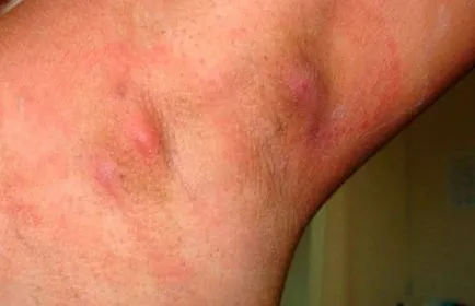 Hidradenitis подмишниците причини, симптоми, лечение