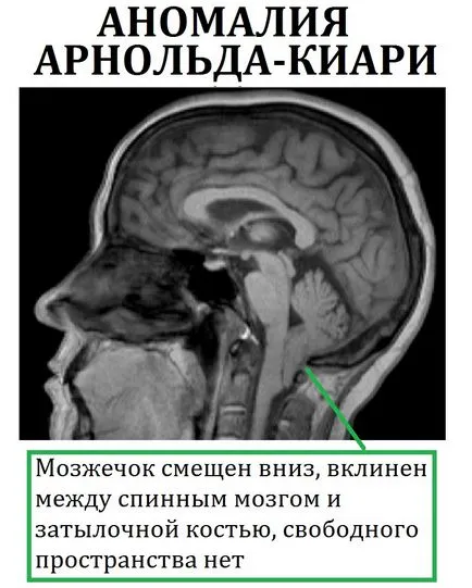 мозъка хидроцефалия в детските симптоми, лечение и възможните последици