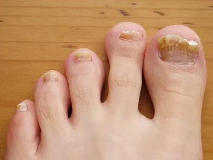 Гъбички на ноктите на краката си, симптоми, причини и лечение