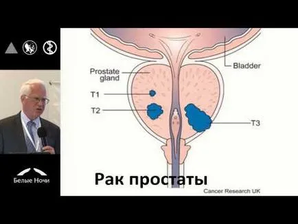 Dependente hormonal si hormon-independent, prognosticul cancerului de san si de tratament la femei