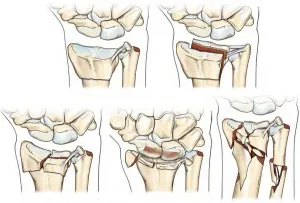 Fractura raza de compensare, sfatul medicului