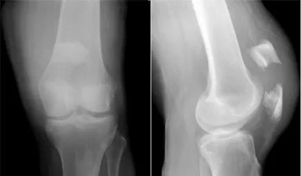 Törések a patella (térdkalács) - hudoshin és