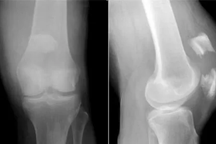 Fractura a genunchiului (patela), simptome, tratament, consecințele