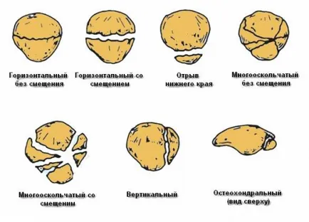 Fracturile rotula (rotula) - hudoshin și