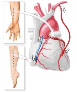 Szívinfarktus bypass műtét - kezelés a szív