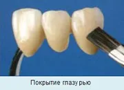 Производство металокерамични (стъпки и технологии), живота на металокерамични зъбни протези и