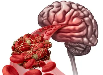 Accident vascular cerebral ischemic - cauze, simptome, tipuri de accident vascular cerebral ischemic