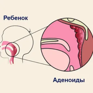 Как да се диша през картофите със студена, вдишване