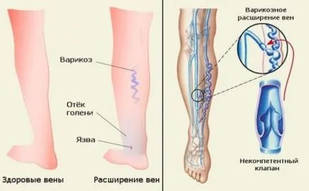 Как да се отървем от методи за лечение на разширени вени, uflebologa