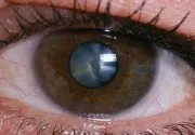Как за лечение на катаракта в началния етап народни средства за защита